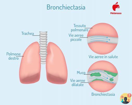 ¿Qué significa engrosamiento de las paredes bronquiales?