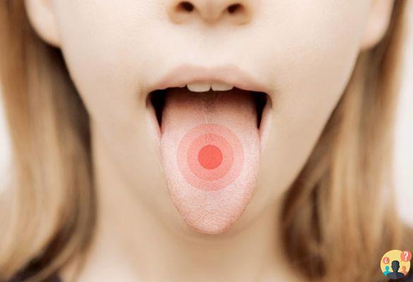 ¿Qué son las pústulas en la lengua?