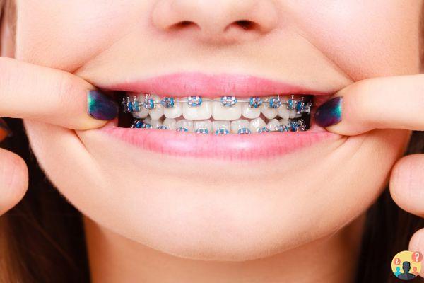 ¿Cuánto cuesta un dispositivo de alineación de dientes?