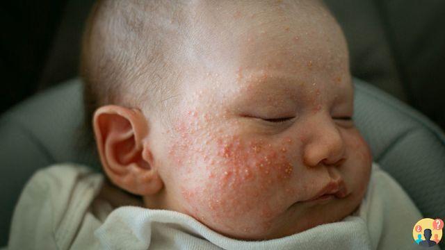 ¿Por qué surge el acné neonatal?