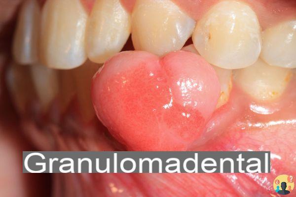 ¿Antibiótico para el granuloma dental?