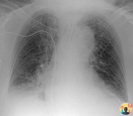 Acentuación de la textura pulmonar con aspecto congestionado de la ili?