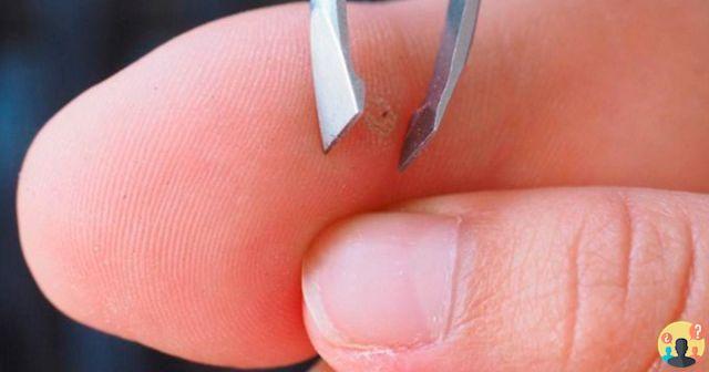 ¿Cómo se quita una astilla del dedo?