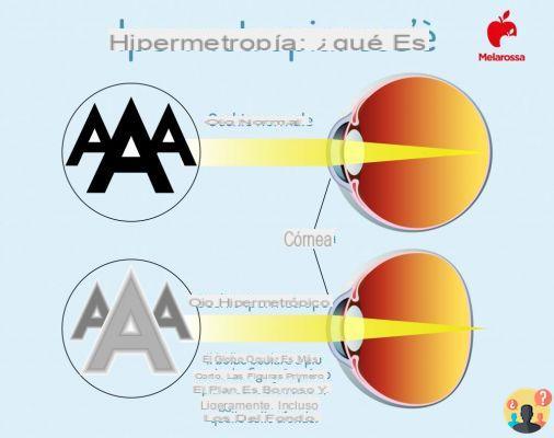 ¿Qué es la hipermetropía?