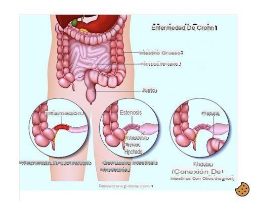¿Válvula ileocecal de la enfermedad de Crohn?
