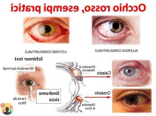 ¿Hiperemia conjuntival del ojo seco?