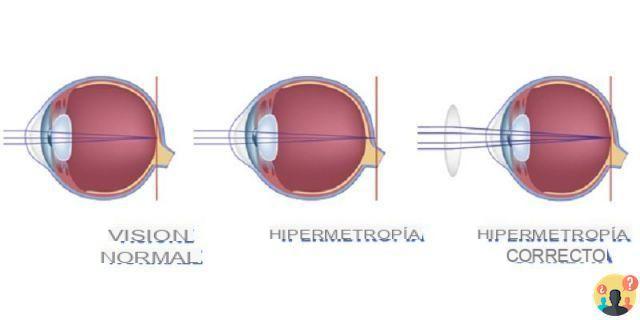 ¿Con qué lente se corrige la hipermetropía?