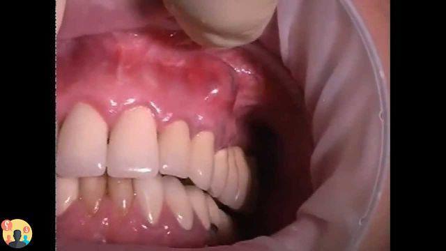 ¿Absceso en diente desvitalizado?