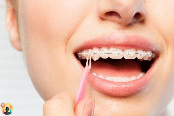 ¿Para qué sirven los elásticos de ortodoncia?