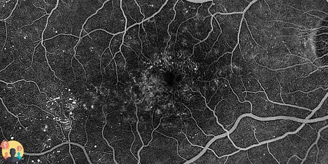 ¿Qué es la fluorangiografía retiniana?
