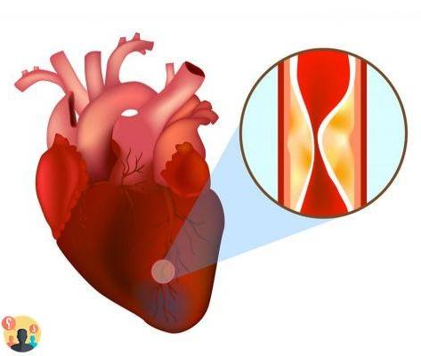 ¿Cómo curar las coronarias obstruidas?