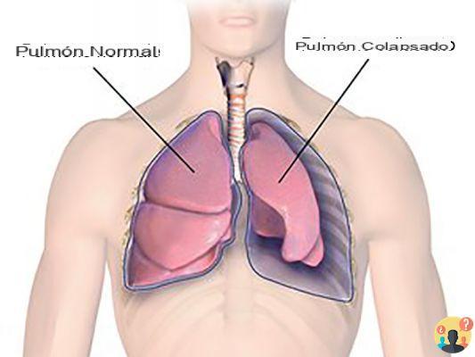 ¿Por qué el pulmón tiende a colapsarse?
