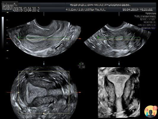 ¿Se puede ver el cáncer de útero con una ecografía?