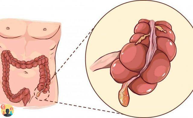 ¿Qué es la apendicitis en el cuerpo humano?