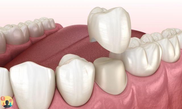 ¿Qué significa encapsular un diente?