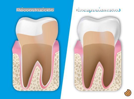 ¿Cuánto duran los dientes desvitalizados?