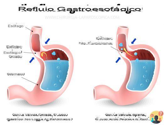 ¿Válvula entre el esófago y el estómago?