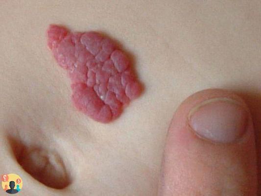 ¿Qué son las marcas de nacimiento en la piel?