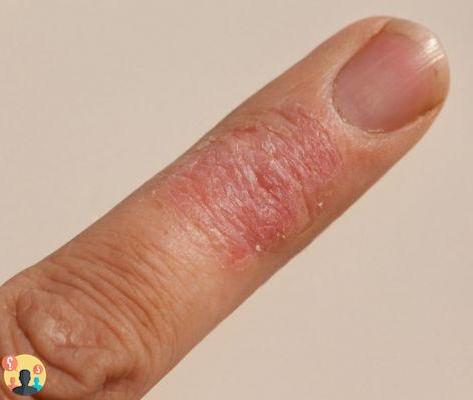 ¿Tiempo de curación de la dermatitis de contacto irritativa?