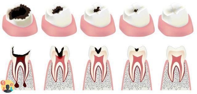 ¿Cómo se eliminan las caries dentales?
