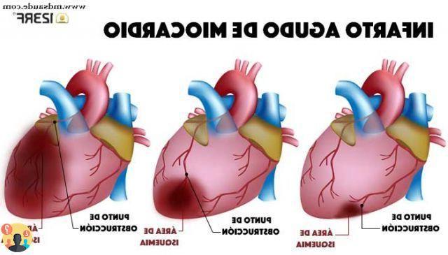 ¿Qué significa infarto fulminante?
