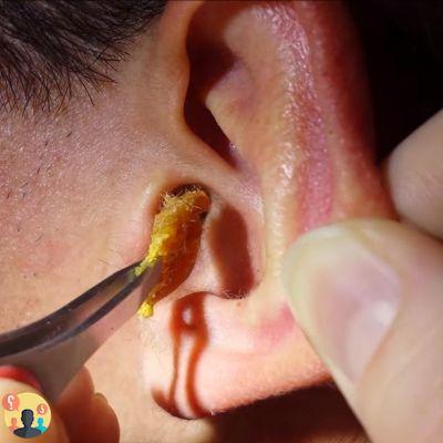 ¿Cómo descorchar la cera del oído?