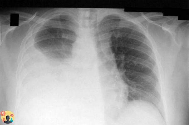 ¿Qué es el engrosamiento del parénquima pulmonar?