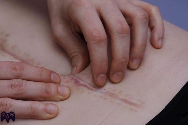 ¿Cómo eliminar las adherencias cicatriciales?