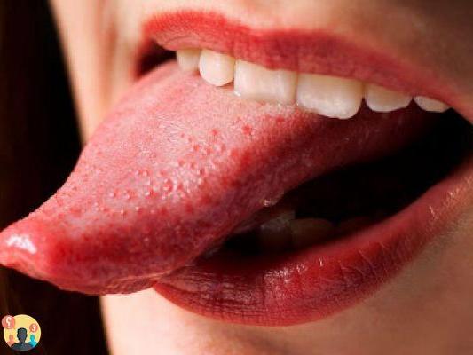¿Cuánto dura la lengua quemada por el sol?