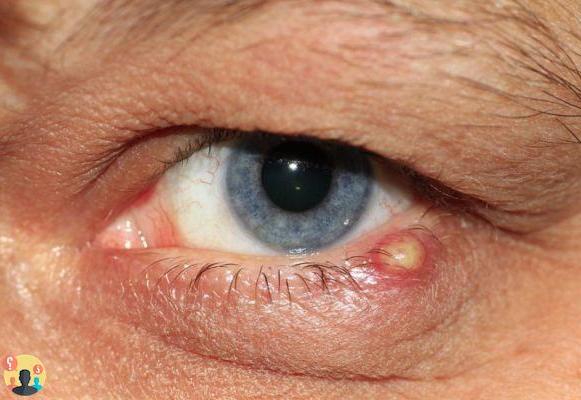 Contorno de ojos rojo y agrietado ¿qué es?