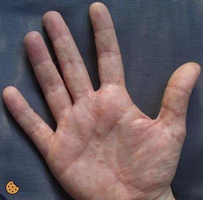 ¿Puntos rojos entre los dedos de la mano?