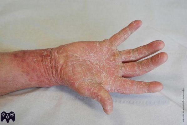 ¿Cómo distinguir una dermatitis de una micosis?